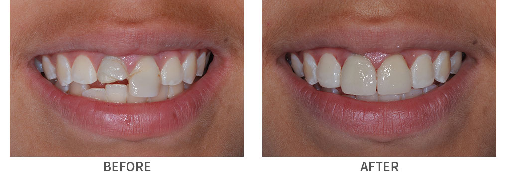 Smile before and after porcelain dental crown placement