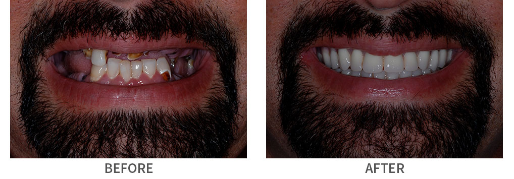 Smile before and after traditional complete dentures placement
