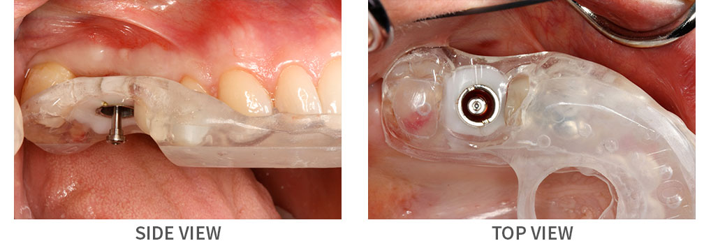 Smile before and after guided dental implant surgery