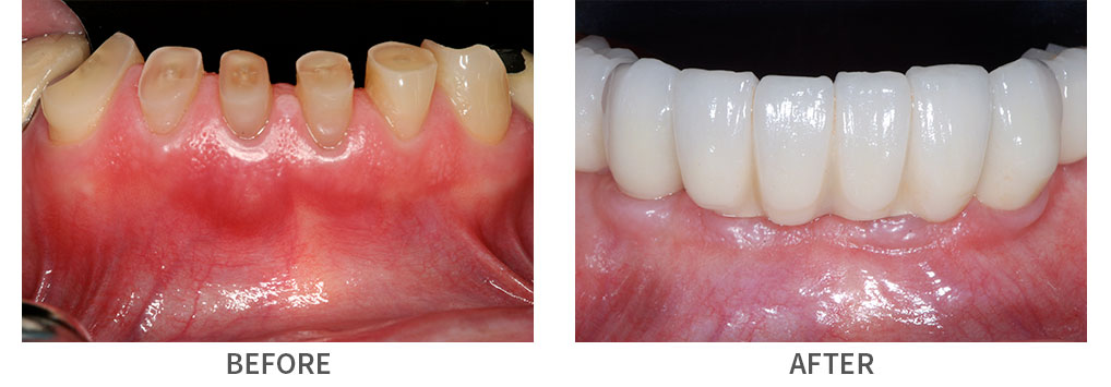 Closeup of smile before and after implant bridge placement