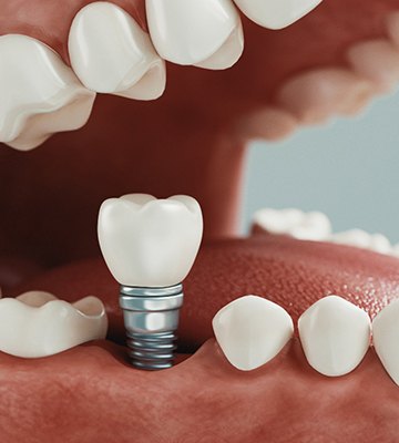 Diagram showing how dental implants in Colleyville are placed