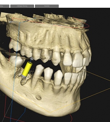 CBCT scan results, being used to plan for dental implants