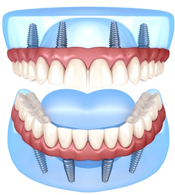 illustration of dental implants supporting upper and lower dentures