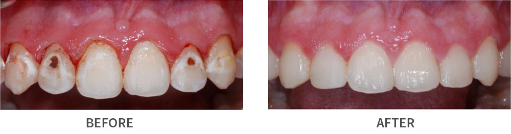 Smile before and after treatment