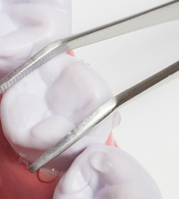 Close-up of simple tooth extraction using forceps
