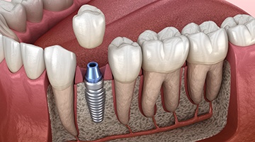 Diagram of an integrated dental implant inside the jaw