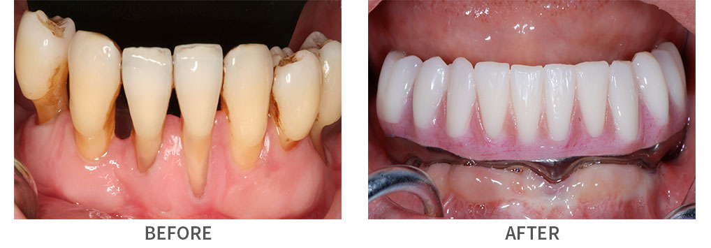 Before and after full arch implant bridge placement