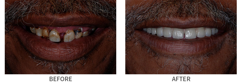 Before and after full arch implant bridge