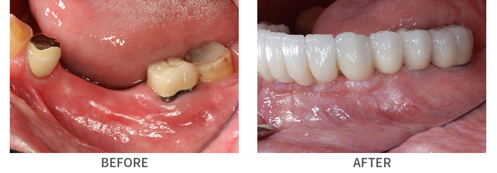 Smile before and after implant bridge restoration