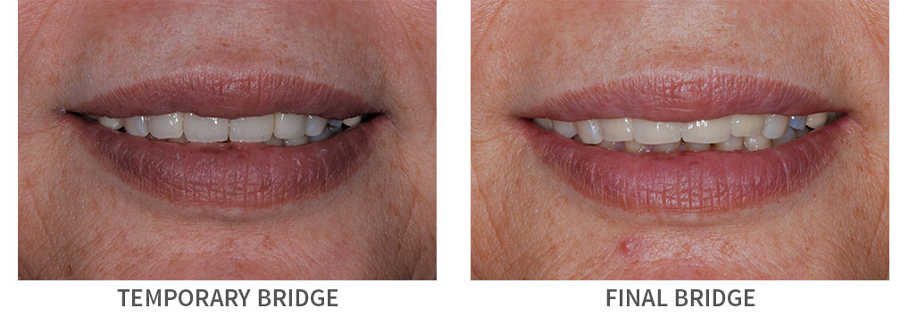 Closeup of smile before and after treatment