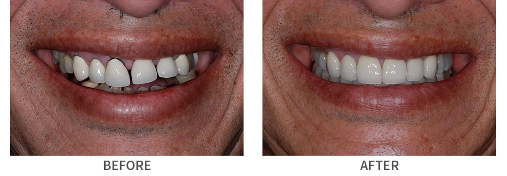 Before and after porcelain crowns and implant bridge placement