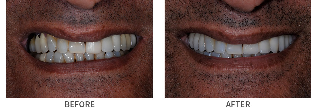 Before and after custom crown and implant bridge placement