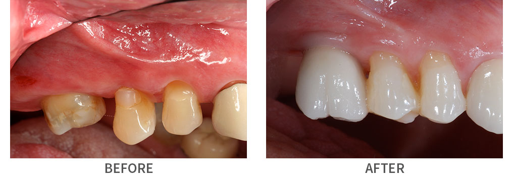 Before and after sinlge implant dental crown placement