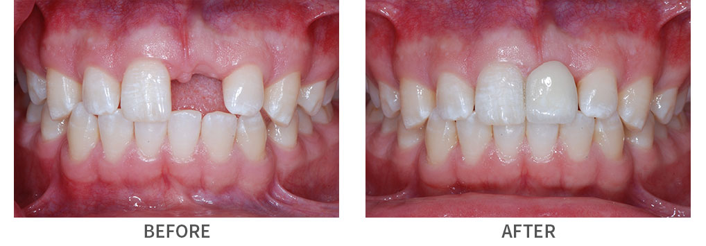 Closeup smile before and after porcelain dental crown placement