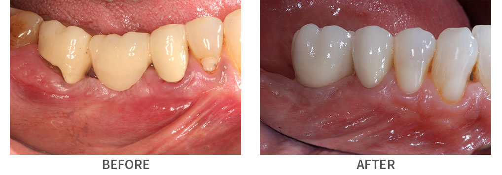 Smile before and after implant crown and fillings placement