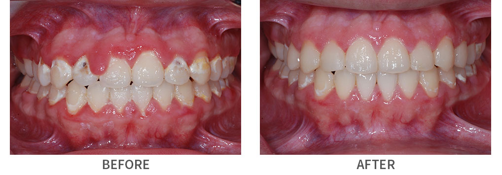Before and after gum surgery and tooth-colored fillings