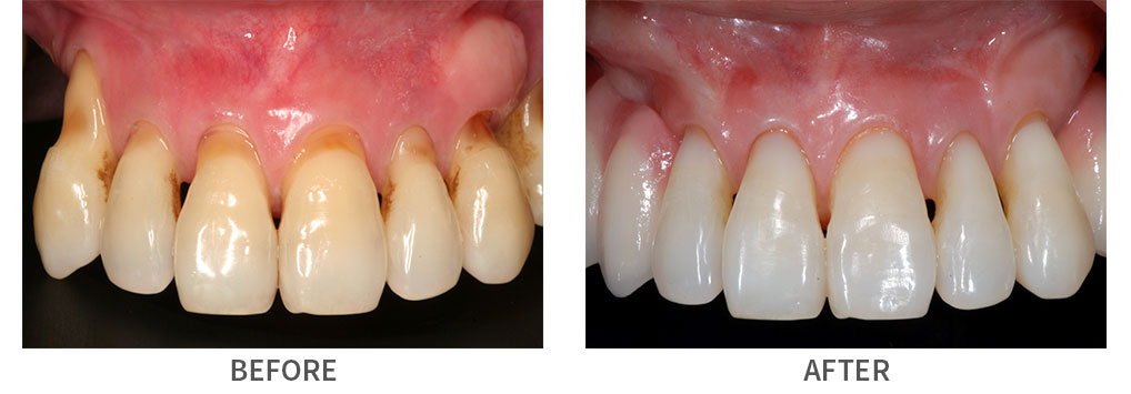 Smile before and after tooth-colored fillings