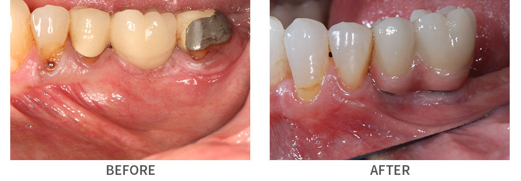 Smile before and after implant bridge placement