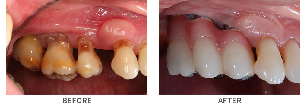 Before and after implant bridge placement