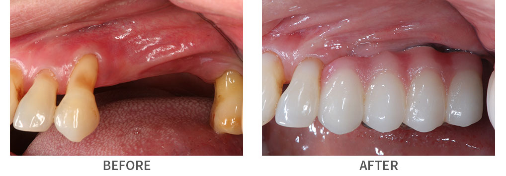 Closeup before and after implant bridge placement