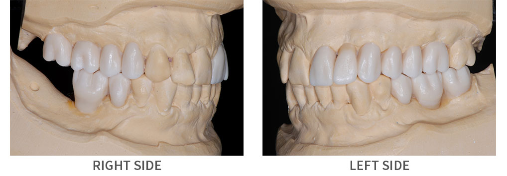 Diagnostic waxup models