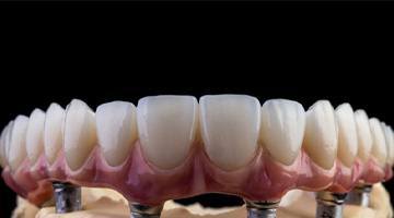 Implant dentures in Colleyville 