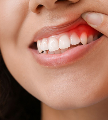 Nose-to-chin view of woman pulling back upper lip to reveal dark red gums
