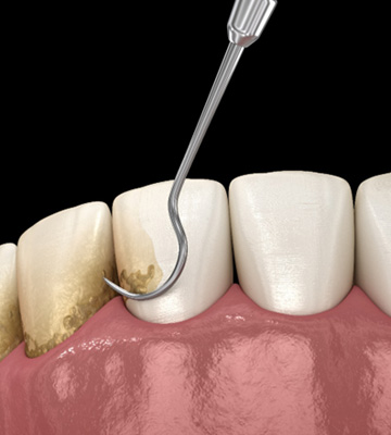 Illustration of dental instrument scraping away plaque with black background