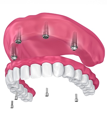 Animation of implant supported bridge