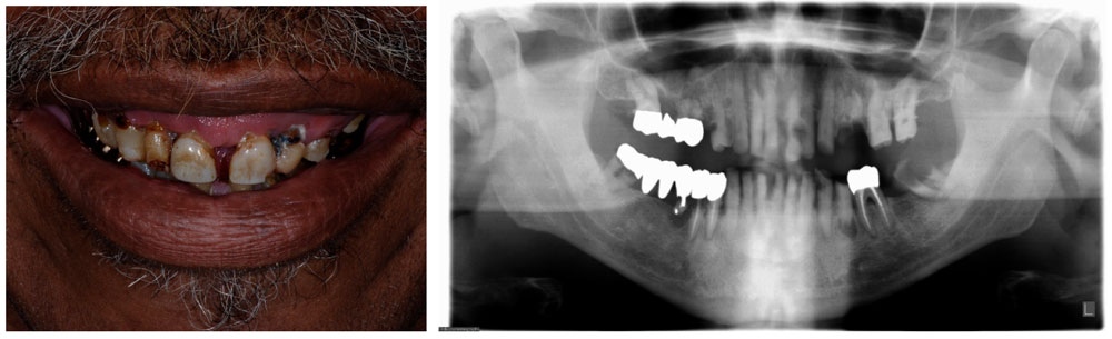 Before and after implant supported bridge placement