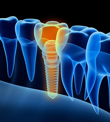 Animation of implant supported dental crown