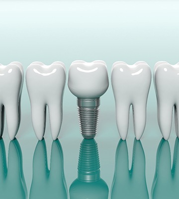 Model teeth next to model dental implant in Colleyville