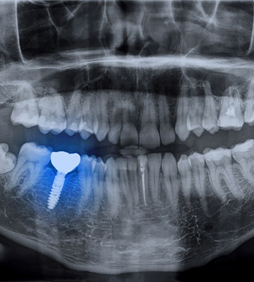 X-ray with blue highlighted dental implant in Colleyville