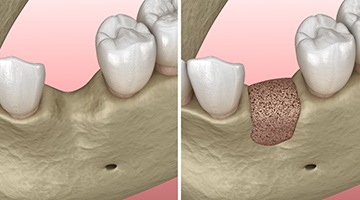 Before and after diagram of bone grafting in Colleyville
