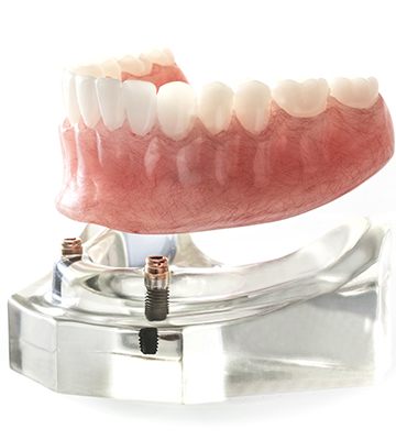 Model implant supported denture