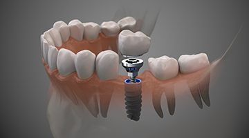 single dental implant supporting a dental crown 