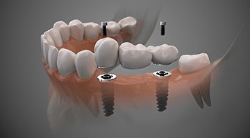 two dental implants supporting a dental bridge