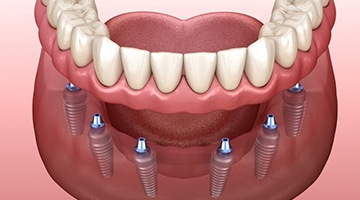 six dental implants supporting a full denture 