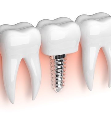 Mini implant supported dental crown animation