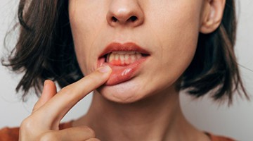 Lady shows inflamed gum tissue
