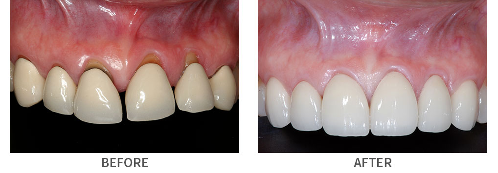 Real patient before and after porcelain dental crown restoration