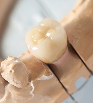 Model smile with BruxZir dental crown