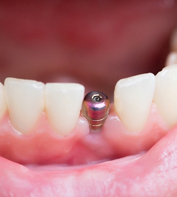 Dental implant in mouth