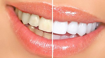 Before and after pictures of teeth whitening in Colleyville, TX