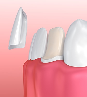 Animation of porcelain veneer placement