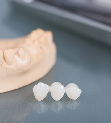 Model smile and zirconia bridge