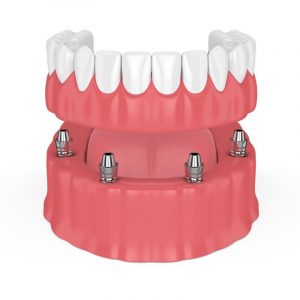 Implant Dentures