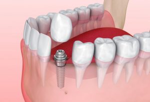 Dental Implant