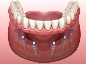 Illustration of implant-supported dentures aiding in jawbone preservation 