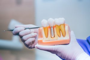 dentist holding a dental implants model